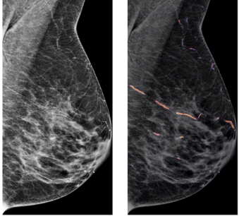 Mammogram showing quantified breast arterial calcification — raw view at left, Avera heatmap overlay at right